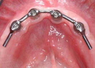 bar overdenture