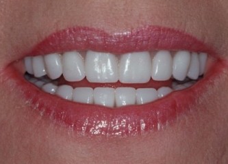 denture 3