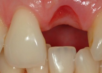 implant case 1