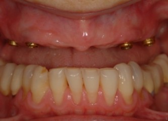 overdenture