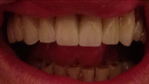 Veritas Dental Care Ceramic Crowns After