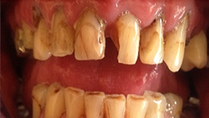 Veritas Dental Care Ceramic Crowns Before