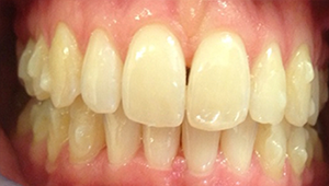 Veritas Dental Care invisalign after