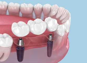 Dental implants for replacing missing teeth at Veritas Dental Care in Harley Street, London