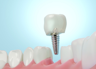 Single dental implant for replacing a missing tooth in Harley Street, London