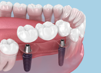 Dental implant bridge for replacing multiple missing teeth in Harley Street
