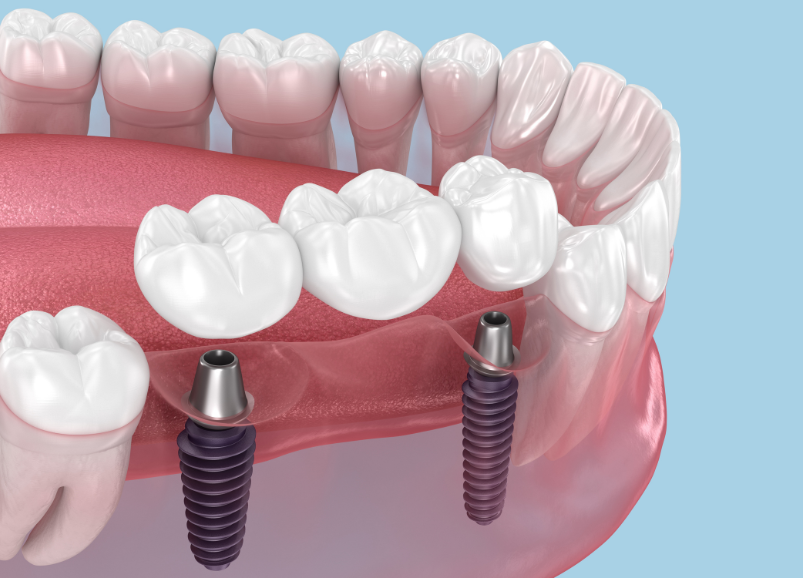Dental implant bridge for replacing multiple missing teeth in Harley Street
