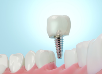 Single dental implant for replacing a missing tooth in Harley Street, London